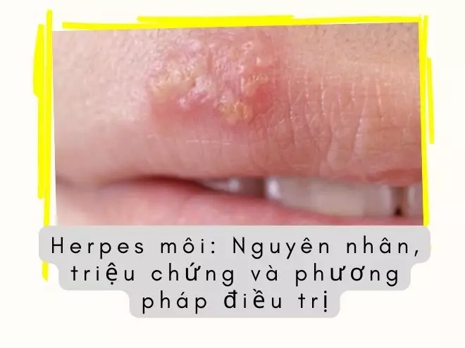 Herpes môi: Nguyên nhân, triệu chứng và phương pháp điều trị